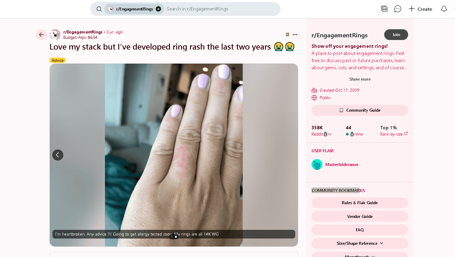Skin rash developed from palladium ring