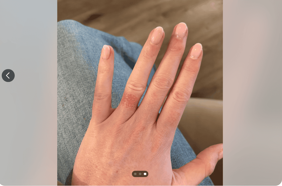 22k gold ring rash example 22k gold ring rash example