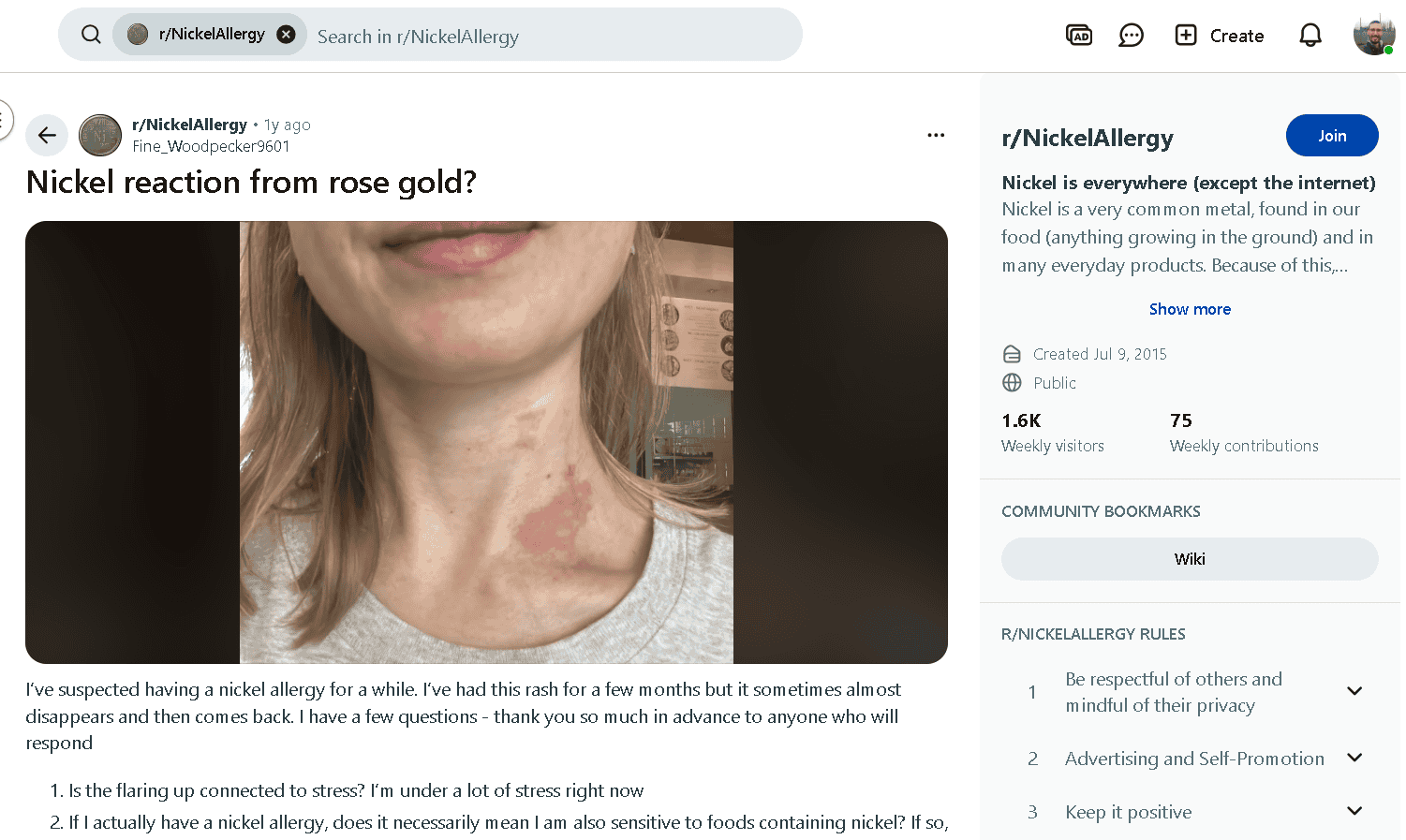 Rose gold vermeil allergy example.