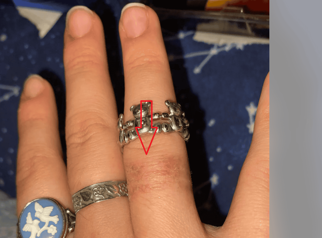 Sterling silver turned a finger green example 3 Sterling silver turned a finger green example 3